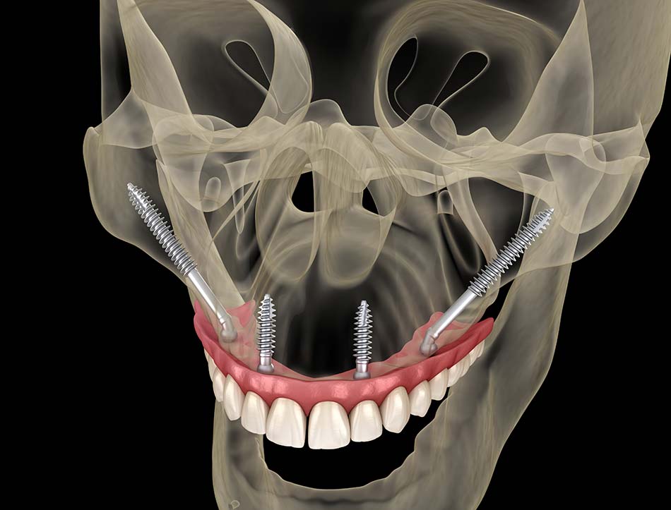 zygomatic dental implants