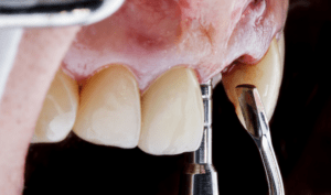 Bone Grafting in Dental Procedure